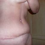 Tummy tuck procedure with liposuction before and after