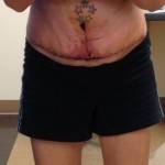 Tummy tuck results pictures (1)