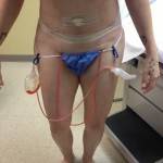 Tummy tuck results pictures (11)