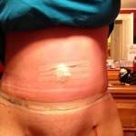 Tummy tuck results pictures (13)