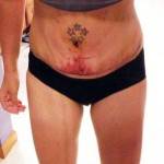 Tummy tuck results pictures (2)