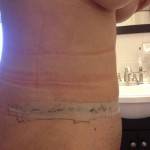 Tummy tuck results pictures (20)