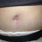 Tummy tuck results pictures (22)