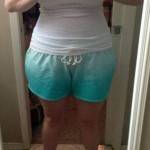 Tummy tuck results pictures (26)