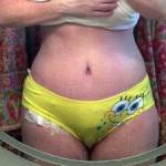 Tummy tuck results pictures (28)