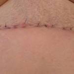 Tummy tuck results pictures (29)