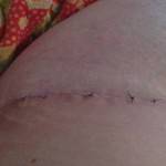 Tummy tuck results pictures (30)
