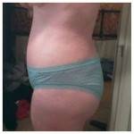 Tummy tuck results pictures (40)