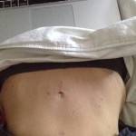 Tummy tuck results pictures (45)