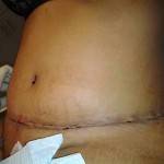 Tummy tuck results pictures (48)