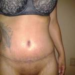 Tummy tuck results pictures (49)