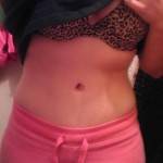 Tummy tuck results pictures (54)