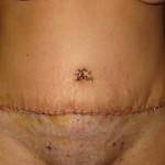 Tummy tuck results pictures (55)