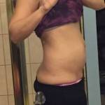 Tummy tuck results pictures after photo