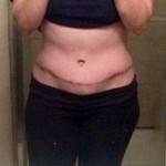 Tummy tuck results pictures album