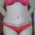 Tummy tuck results pictures and images