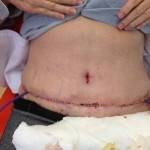 Tummy tuck results pictures best plastic surgeons