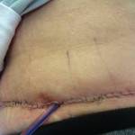 Tummy tuck results pictures drains