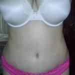 Tummy tuck results pictures gallery after