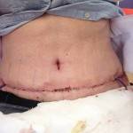 Tummy tuck results pictures of top surgeons