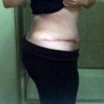 Tummy tuck results pictures patients