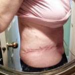 Tummy tuck results scar pictures