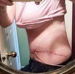 Tummy tuck results scars pictures