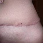 Tummy tuck scar good with liposuction before and after