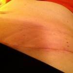 Tummy tuck scar with liposuction before and after