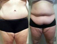Tummy tuck surgery on obese patients