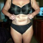 Tummy tuck with liposuction before and after (1)