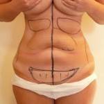 Tummy tuck with liposuction before and after (10)