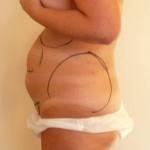 Tummy tuck with liposuction before and after (12)