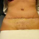 Tummy tuck with liposuction before and after (21)