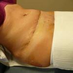 Tummy tuck with liposuction before and after (22)