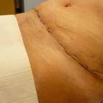 Tummy tuck with liposuction before and after (24)