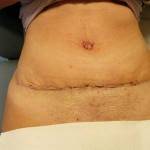 Tummy tuck with liposuction before and after (25)