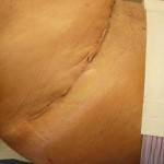 Tummy tuck with liposuction before and after (26)