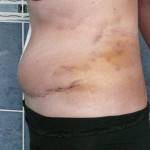 Tummy tuck with liposuction before and after (28)