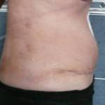 Tummy tuck with liposuction before and after (29)