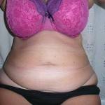 Tummy tuck with liposuction before and after (3)