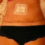 Tummy tuck with liposuction before and after (30)