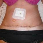 Tummy tuck with liposuction before and after (31)