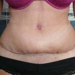 Tummy tuck with liposuction before and after (32)