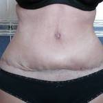 Tummy tuck with liposuction before and after (33)