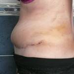 Tummy tuck with liposuction before and after (34)