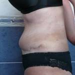 Tummy tuck with liposuction before and after (35)