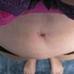 Tummy tuck with liposuction before and after (36)