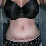 Tummy tuck with liposuction before and after (37)
