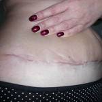 Tummy tuck with liposuction before and after (42)
